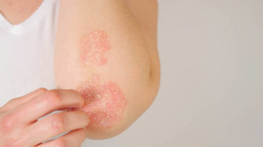 Suffering from Psoriasis? You Don't Have To!